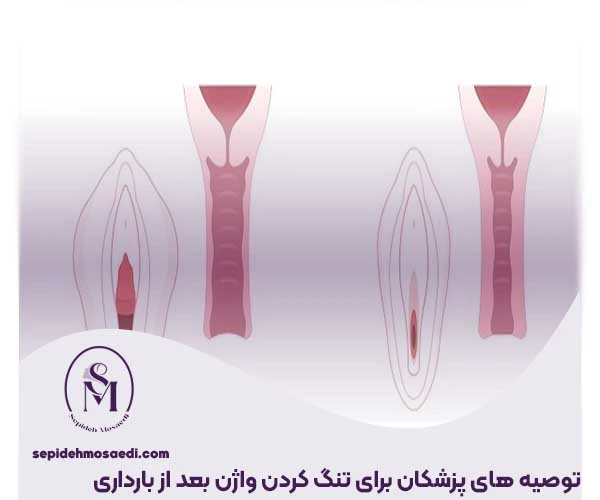تنگ کردن واژن بعد از بارداری، بررسی علمی و پزشکی بهترین روش ها 4 توصیه های پزشکان برای تنگ کردن واژن بعد از بارداری