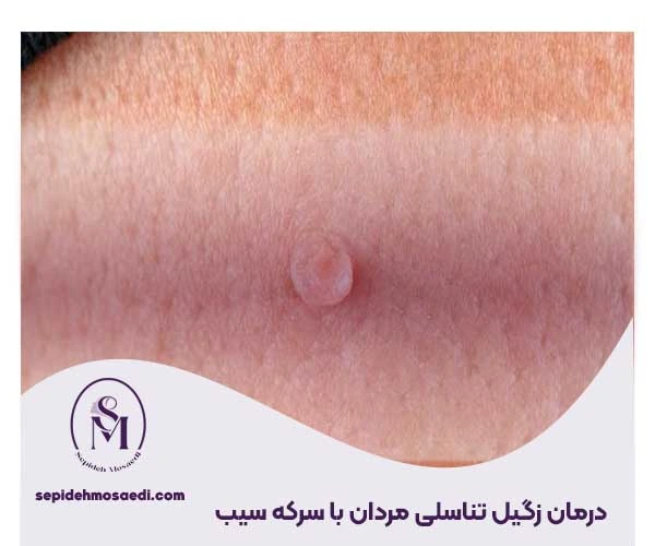 درمان زگیل تناسلی با سرکه سیب؛ بررسی علمی، مزایا و خطرات 2 درمان زگیل تناسلی مردان با سرکه سیب