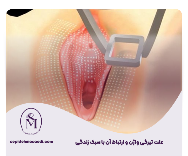 علت تیرگی واژن چیست؟ دلایل علمی و بررسی تخصصی 1 علت تیرگی واژن و ارتباط آن با سبک زندگی