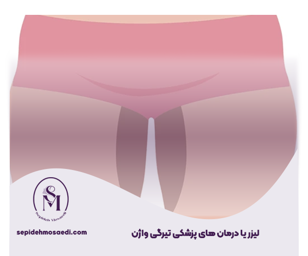 علت تیرگی واژن چیست؟ دلایل علمی و بررسی تخصصی 4 لیزر یا درمان های پزشکی تیرگی واژن