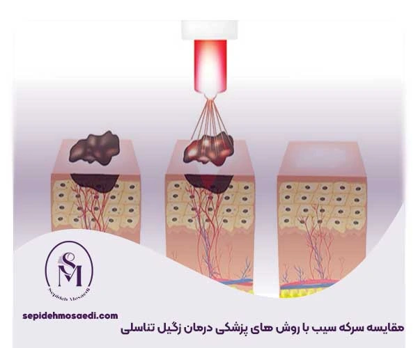 درمان زگیل تناسلی با سرکه سیب؛ بررسی علمی، مزایا و خطرات 4 مقایسه سرکه سیب با روش های پزشکی درمان زگیل تناسلی