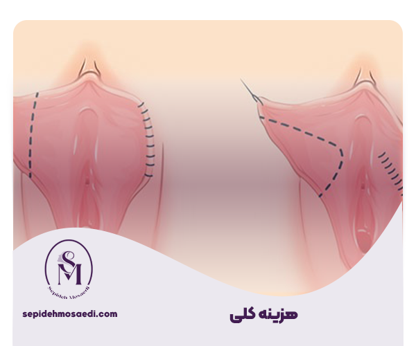 هزینه عمل لابیاپلاستی 2 هزینه کلی