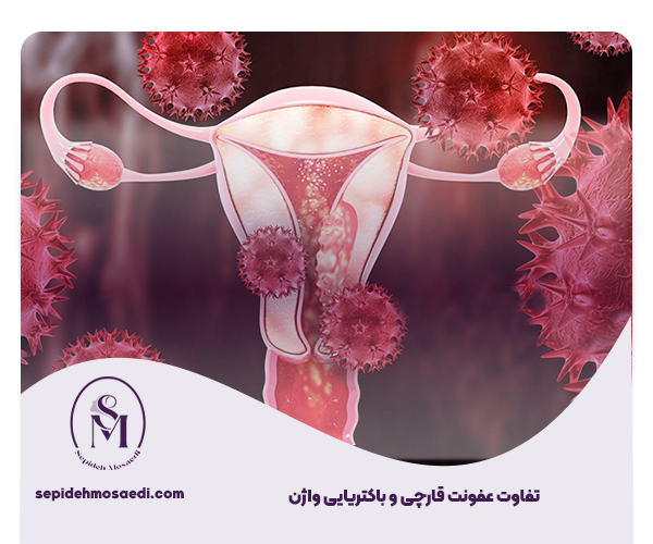 تفاوت عفونت قارچی و باکتریایی واژن
