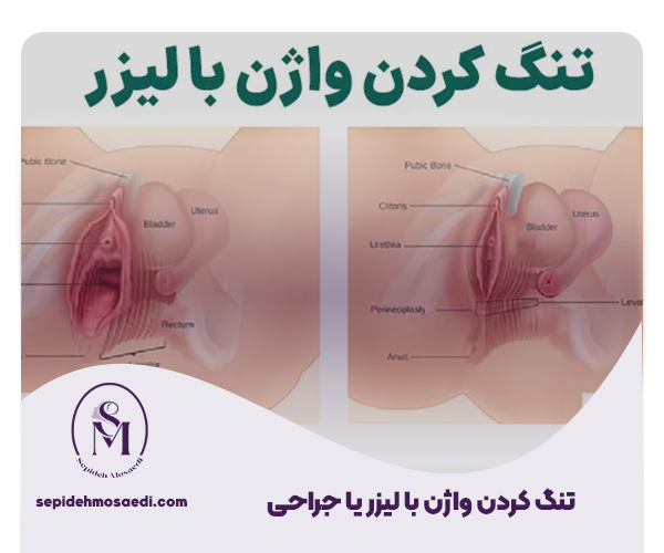 تنگ کردن واژن با لیزر (واژینوپلاستی با لیزر): بررسی هزینه، ماندگاری و تعداد جلسات 6 تنگ کردن واژن با لیزر یا جراحی