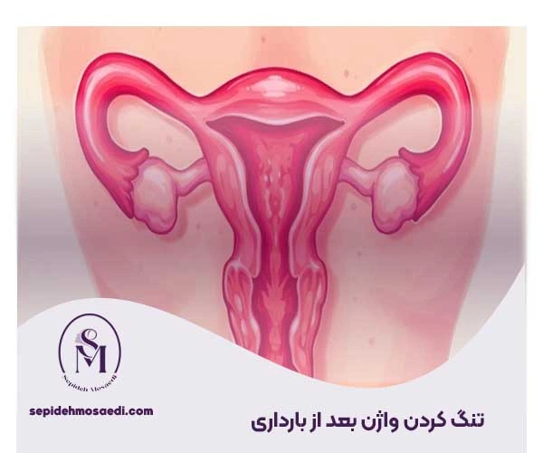 تنگ کردن واژن بعد از بارداری