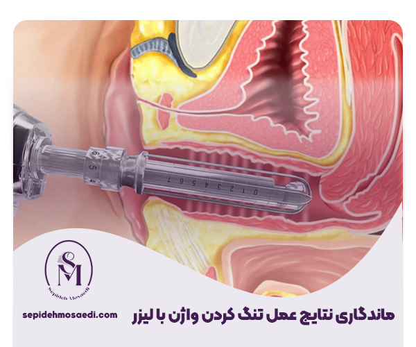 تنگ کردن واژن با لیزر (واژینوپلاستی با لیزر): بررسی هزینه، ماندگاری و تعداد جلسات 4 ماندگاری نتایج عمل تنگ کردن واژن با لیزر