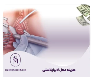 هزینه عمل لابیاپلاستی
