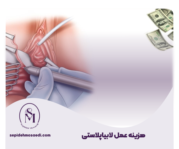 هزینه عمل لابیاپلاستی