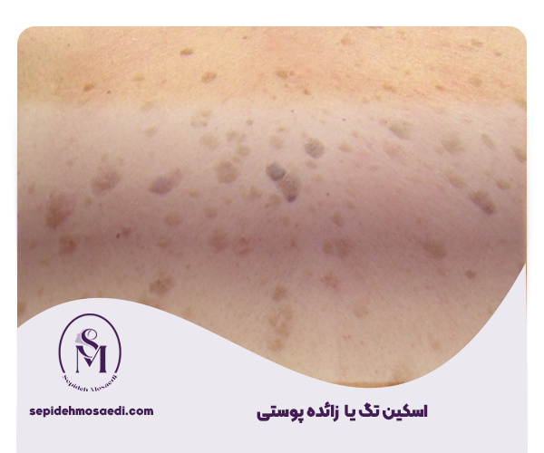 زائده شبیه زگیل تناسلی، ضایعات و بیماری هایی که با زگیل تناسلی اشتباه گرفته میشوند 1 اسکین تگ (Skin tags) یا زائده پوستی