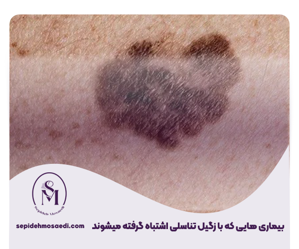 بیماری هایی که با زگیل تناسلی اشتباه گرفته میشوند