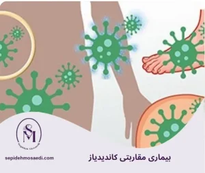 وبلاگ 4 کاندیدیاز چیست