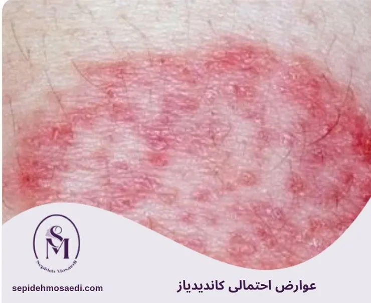 کاندیدیاز چیست؟ علائم، علل و درمان قطعی عفونت قارچی 5 عوارض احتمالی کاندیدیاز