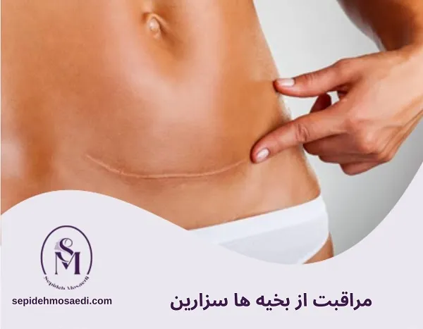 مراقبت های بعد از زایمان: راهنمای کامل سلامت جسم و روان مادر 1 مراقبت از بخیه های سزارین