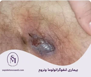 وبلاگ 3 لنفوگرانولوما ونروم