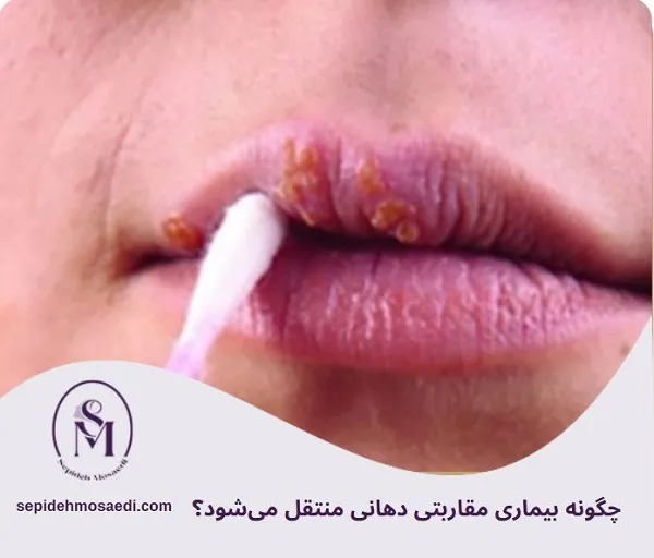 بیماری مقاربتی دهانی چیست؟ علائم، راههای انتقال و درمان کامل 1 چگونه بیماری مقاربتی دهانی منتقل میشود؟
