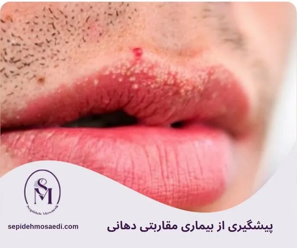 بیماری مقاربتی دهانی چیست؟ علائم، راههای انتقال و درمان کامل 5 پیشگیری از بیماری مقاربتی دهانی