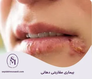 وبلاگ 2 بیماری مقاربتی دهانی چیست؟ علائم، راههای انتقال و درمان کامل