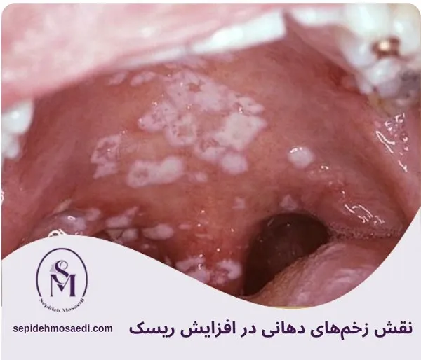 بیماری مقاربتی دهانی چیست؟ علائم، راههای انتقال و درمان کامل 2 نقش زخمهای دهانی در افزایش ریسک بیماری دهانی مقاربتی