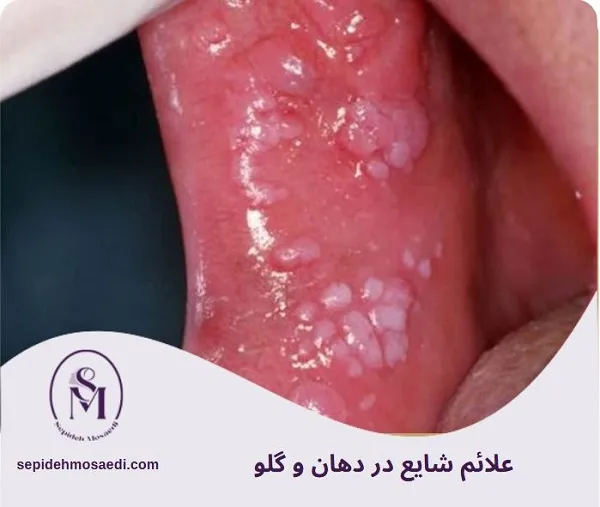 بیماری مقاربتی دهانی چیست؟ علائم، راههای انتقال و درمان کامل 3 علائم شایع در دهان و گلو بیماری مقاربتی