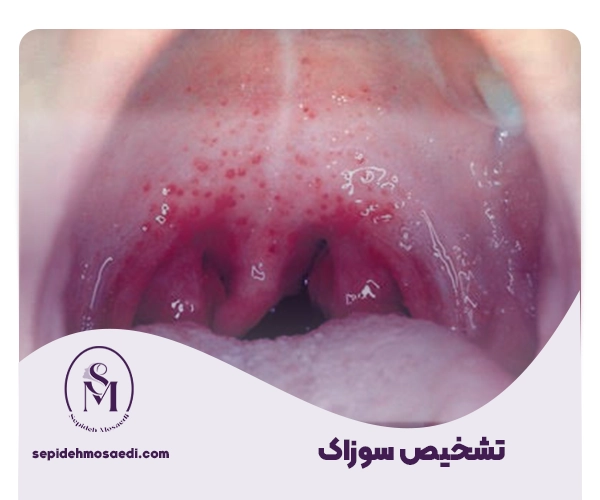 سوزاک چگونه تشخیص داده میشود؟ 2 تشخیص سوزاک