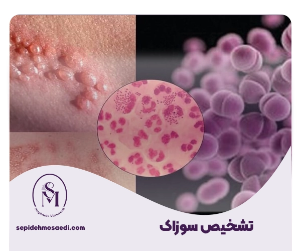 سوزاک چگونه تشخیص داده میشود؟ 1 تشخیص سوزاک