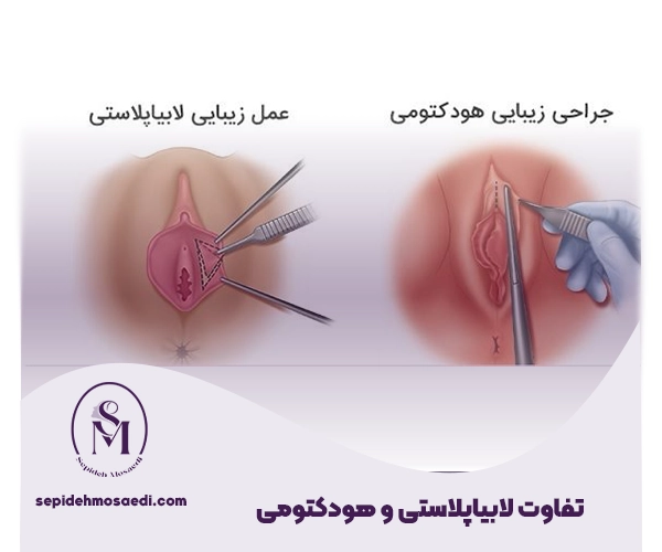 تفاوت لابیاپلاستی و هودکتومی 1 تفاوت لابیاپلاستی و هودکتومی