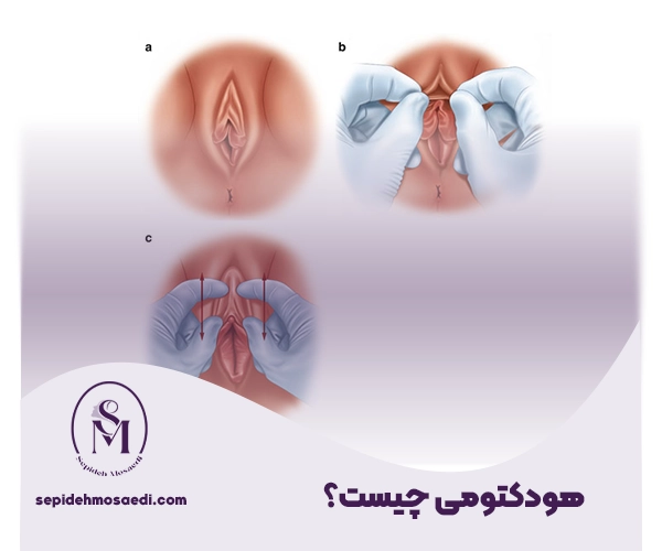 هودکتومی چیست؟ 2 مراحل انجام هودکتومی