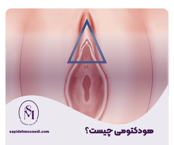 هودکتومی چیست؟ 3 Hoodectomy