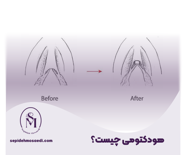 هودکتومی چیست؟ 1 هودکتومی