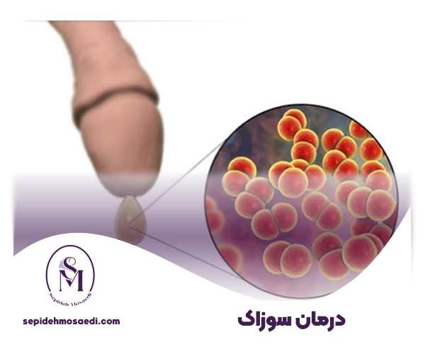 درمان سوزاک چیست؟ 4 درمان بیماری سوزاک