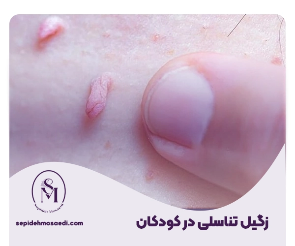 زگیل تناسلی در کودکان؛ علل، علائم و روشهای قطعی درمان 1 زگیل تناسلی در کودکان