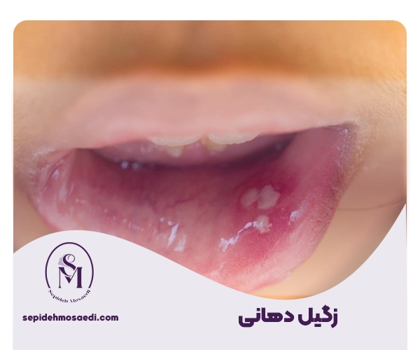 زگیل دهانی چیست و چگونه منتقل می شود؟ 1 زکیل دهانی