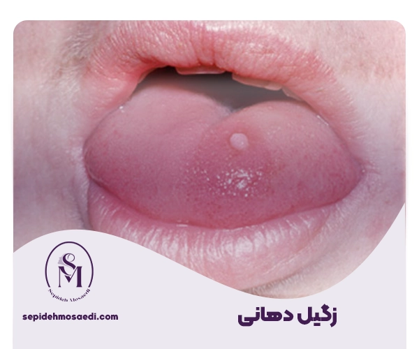زگیل دهانی چیست و چگونه منتقل می شود؟ 3 Oral Wart
