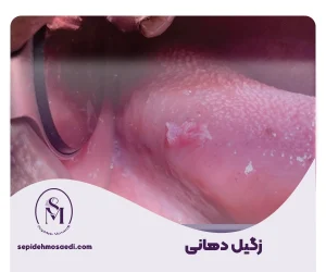 سپیده مساعدی جراحی زیبایی زنان 29 زگیل دهانی