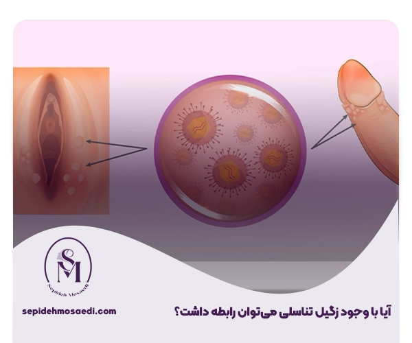 آیا با وجود زگیل تناسلی میتوان رابطه داشت؟ 1 رابطه جنسی با زگیل تناسلی
