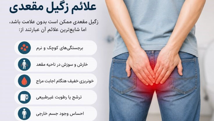 زگیل مقعدی - هر آنچه باید درباره علائم، درمان و پیشگیری بدانید 1 علائم زگیل مقعدی