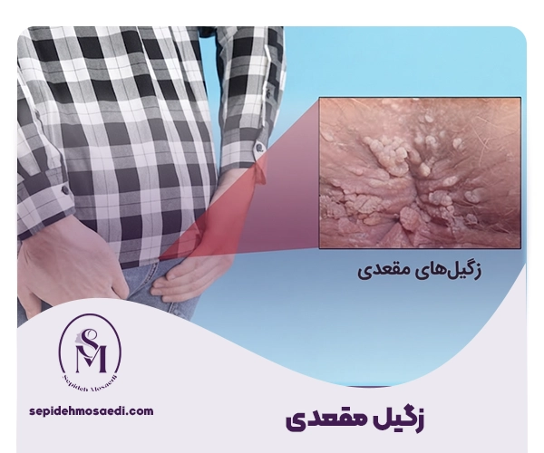 زگیل مقعدی - هر آنچه باید درباره علائم، درمان و پیشگیری بدانید 2 تشخیص زگیل مقعدی