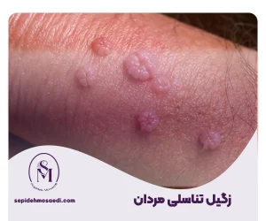 سپیده مساعدی جراحی زیبایی زنان 29 Genital warts in men