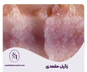 زگیل مقعدی