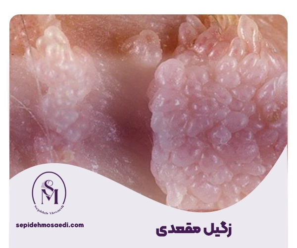 زگیل مقعدی