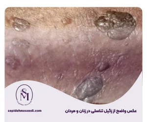 عکس واضح از زگیل تناسلی