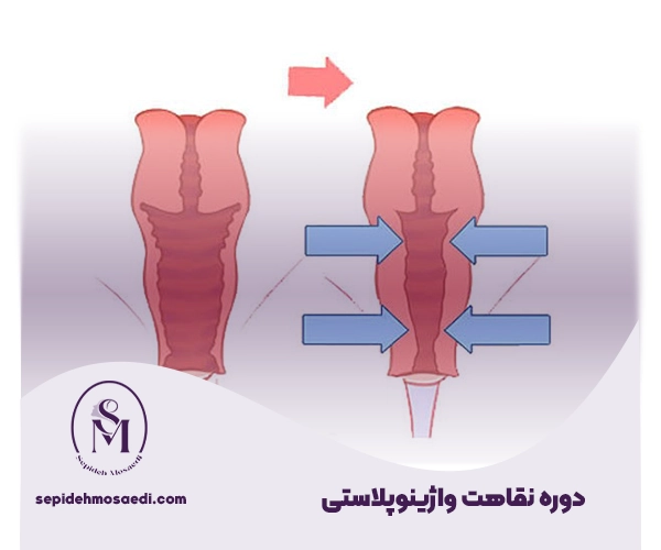 جراحی واژینوپلاستی چگونه انجام می شود؟ 2 دوره نقاهت واژینوپلاستی