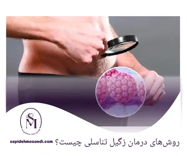 بهترین روش درمان زگیل تناسلی چیست؟ مقایسه روش های درمانی 1 روش_های درمان زگیل تناسلی چیست؟