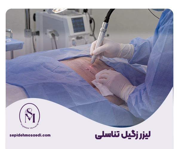 لیزر زگیل تناسلی
