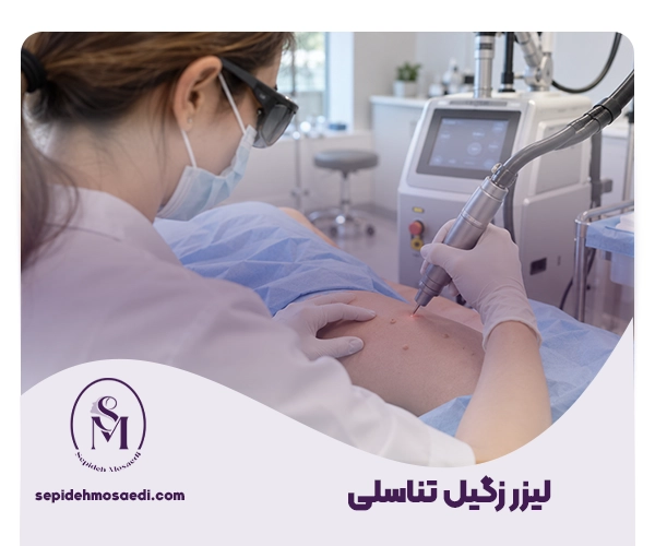 لیزر زگیل تناسلی