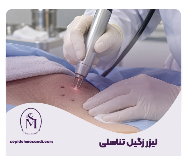 لیزر زگیل تناسلی
